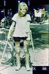 Polio Leg Braces and Crutches 1960s - Ken Oder